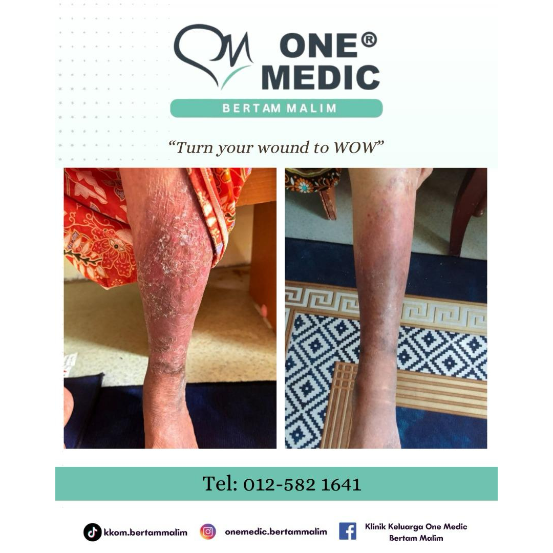 b4 & after wound care
